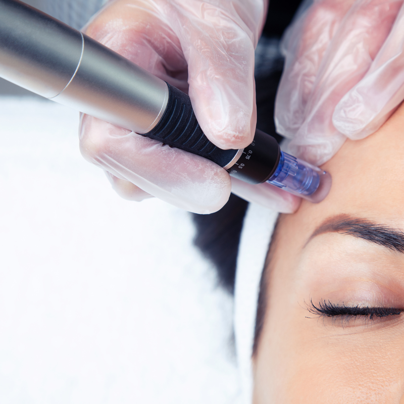 Exosom-Behandlung oder Microneedling – Was ist der Unterschied?